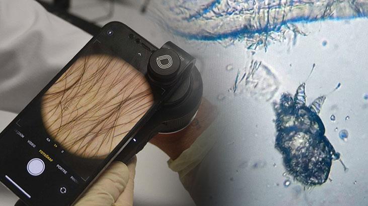 Geceleri artan kaşıntı en önemli belirti! Bu şikayetleriniz varsa dikkat