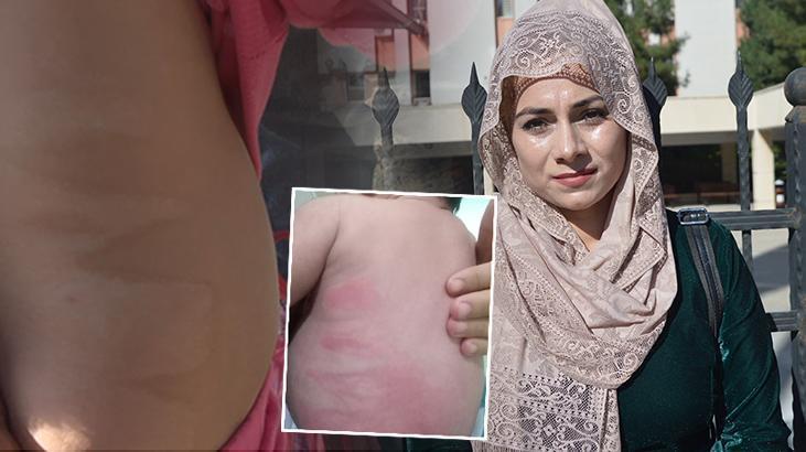 Hastanede yatan bebekte yanık izleri! ‘Doktor raporu’ istan ettirdi
