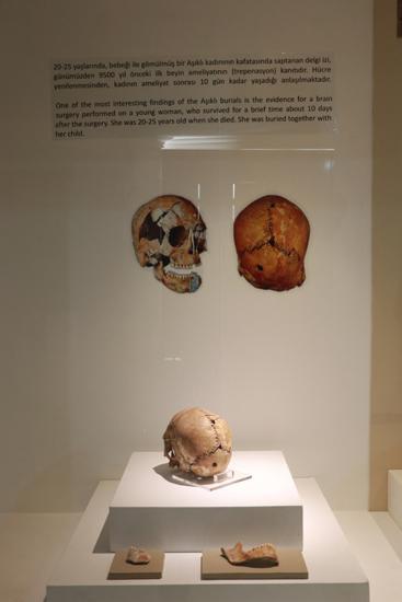 Yer: Aksaray! Dünyanın ilk beyin ameliyatında şaşırtan detay