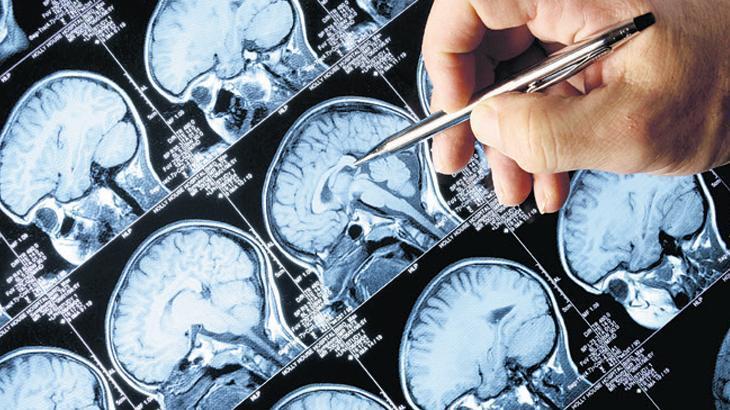 Sigara, Alzheimer riskini artırıyor