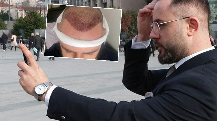 Saç ekimi sonrası ortaya çıkan görüntü mahkemede bitti: Ayıplı işlem