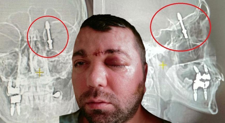 Amerikan dergilere konu olan Türk! Beyne saplanan vida