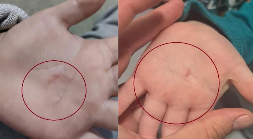 Kreşte korkunç olay! Öğretmen, küçük çocuğun avuçlarını tırnaklayarak kanattı