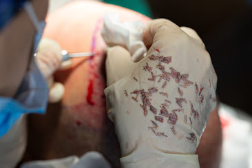 Clinista Saç Ekim Merkezi’nde Doğal ve Kalıcı Saç Ekimi