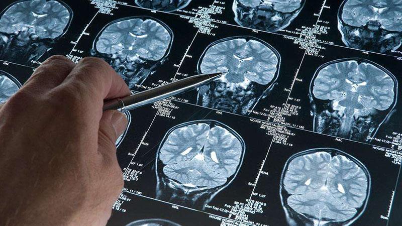 Alzheimer’da “Gizli Evre” Keşfedildi: Biyolojik Değişimler 50’li Yaşlarda Başlıyor!