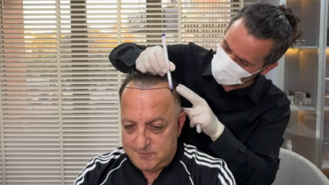 Samet Ergen’den Avrupa’ya Açılan Saç Ekimi Vizyonu: İtalya’dan İstanbul’a Uzanan Yolculuk